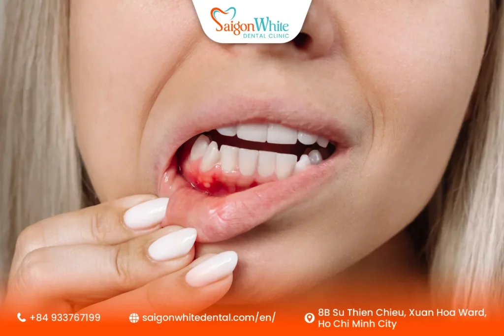 Swollen or Red Gums