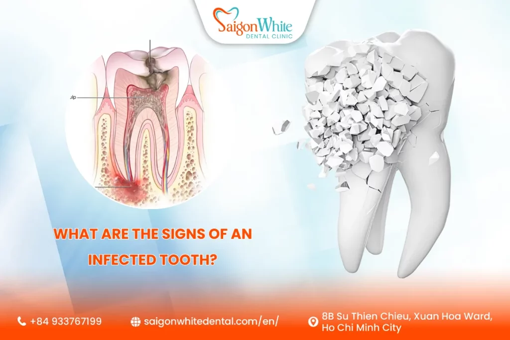 What are the signs of an infected tooth?