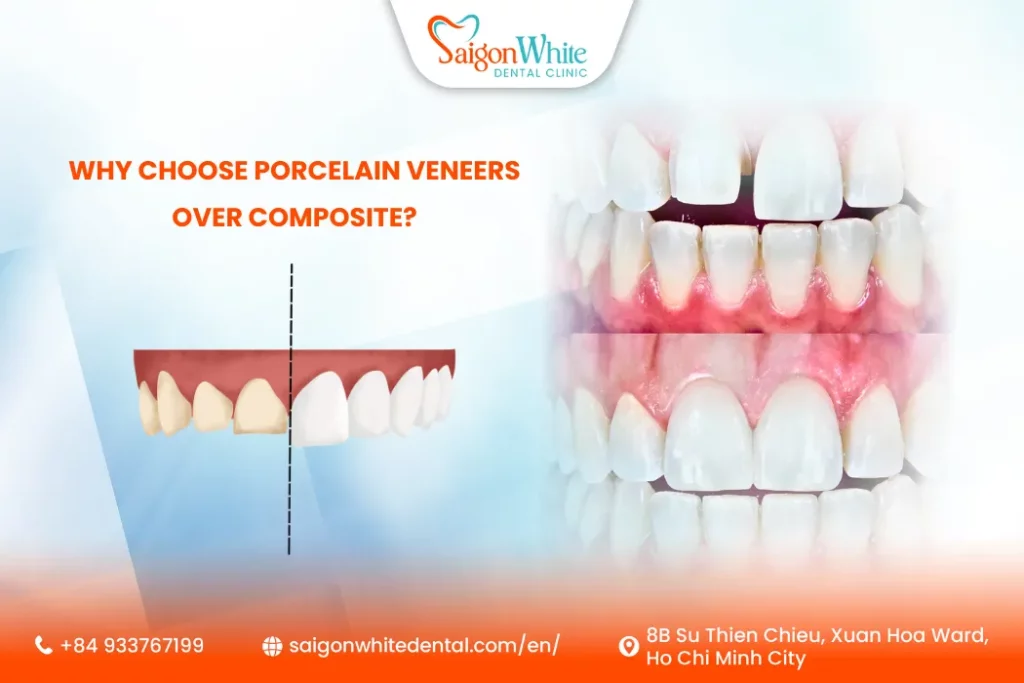 Why choose porcelain veneers over composite?
