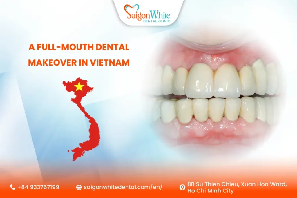 Where Can I Do a Full-Mouth Dental Makeover in Vietnam?