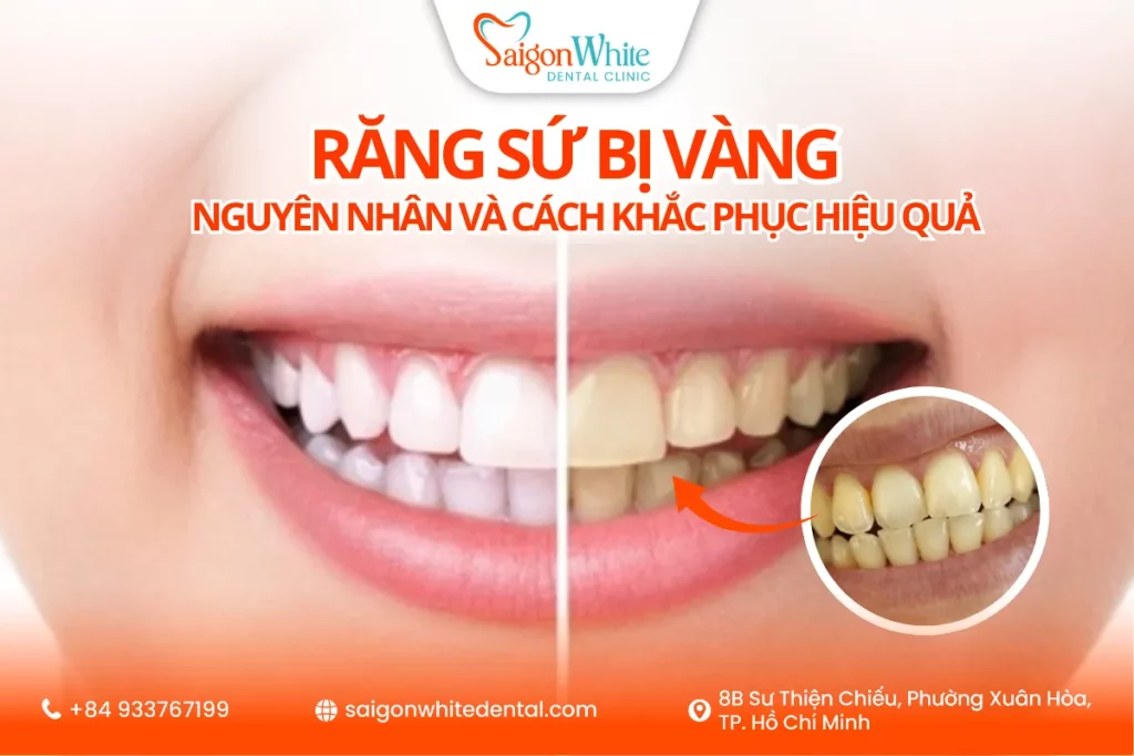 Răng sứ bị vàng – Nguyên nhân và cách khắc phục hiệu quả