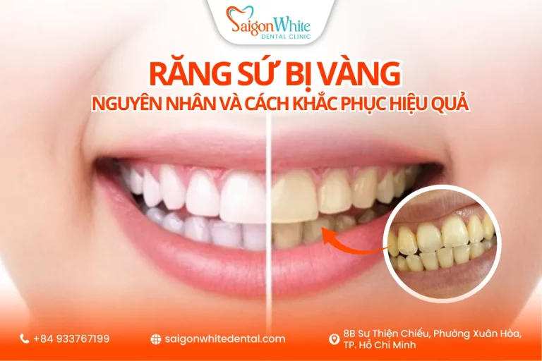 Răng sứ bị vàng – Nguyên nhân và cách khắc phục hiệu quả