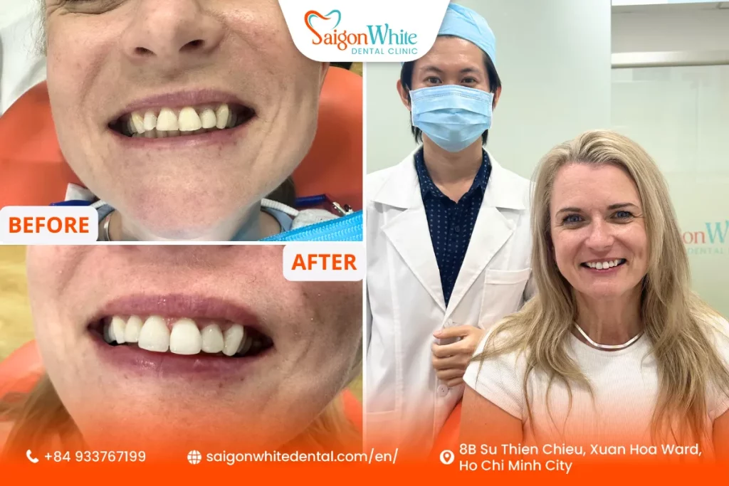 Before and after teeth whitening and composite bonding