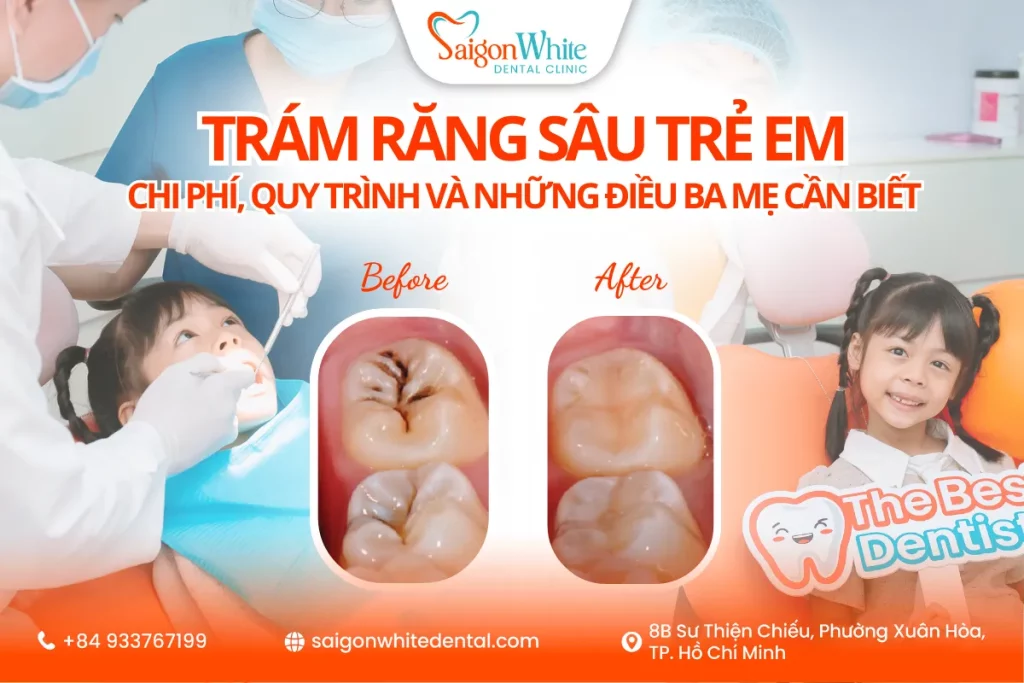 Trám răng sâu trẻ em: Chi phí, quy trình và những điều ba mẹ cần biết