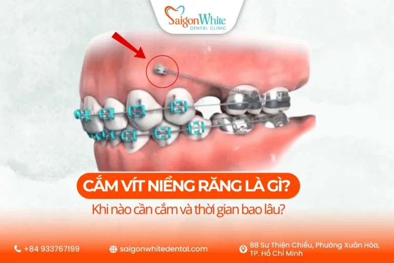 Cắm vít niềng răng là gì?