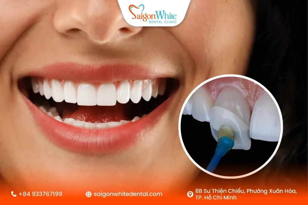 Dán sứ Veneer sau niềng răng