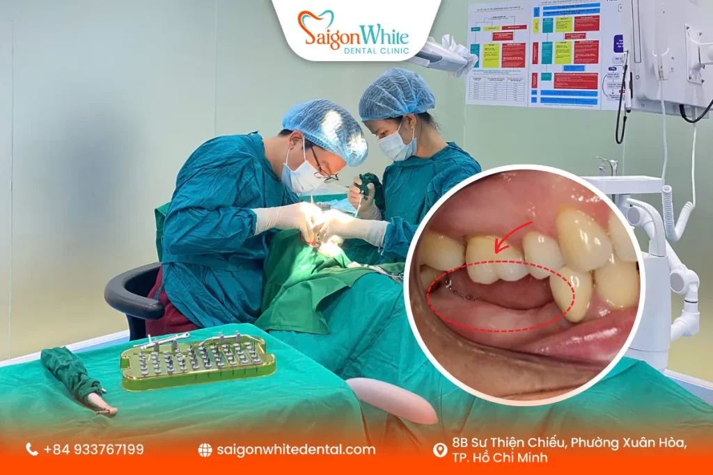 Quy trình trồng răng implant bị tiêu xương hàm