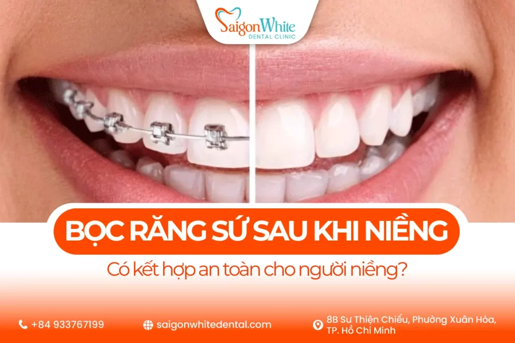 Bọc răng sứ sau khi niềng 