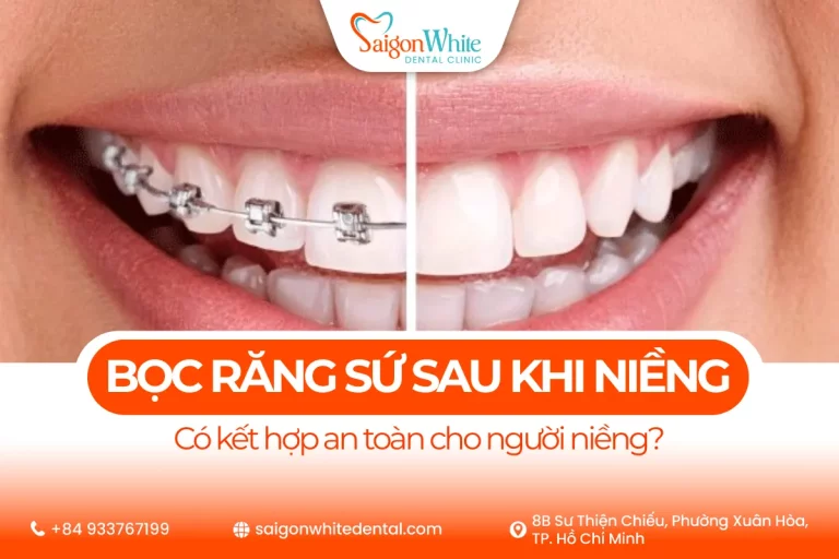 Bọc răng sứ sau khi niềng