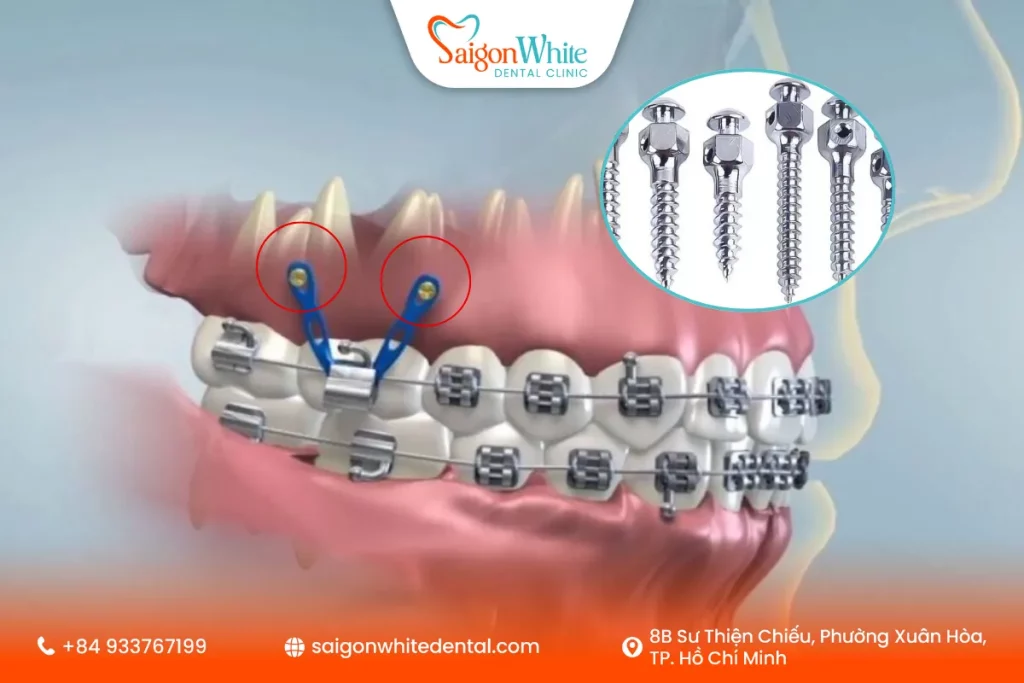 Cây vít cắm niềng