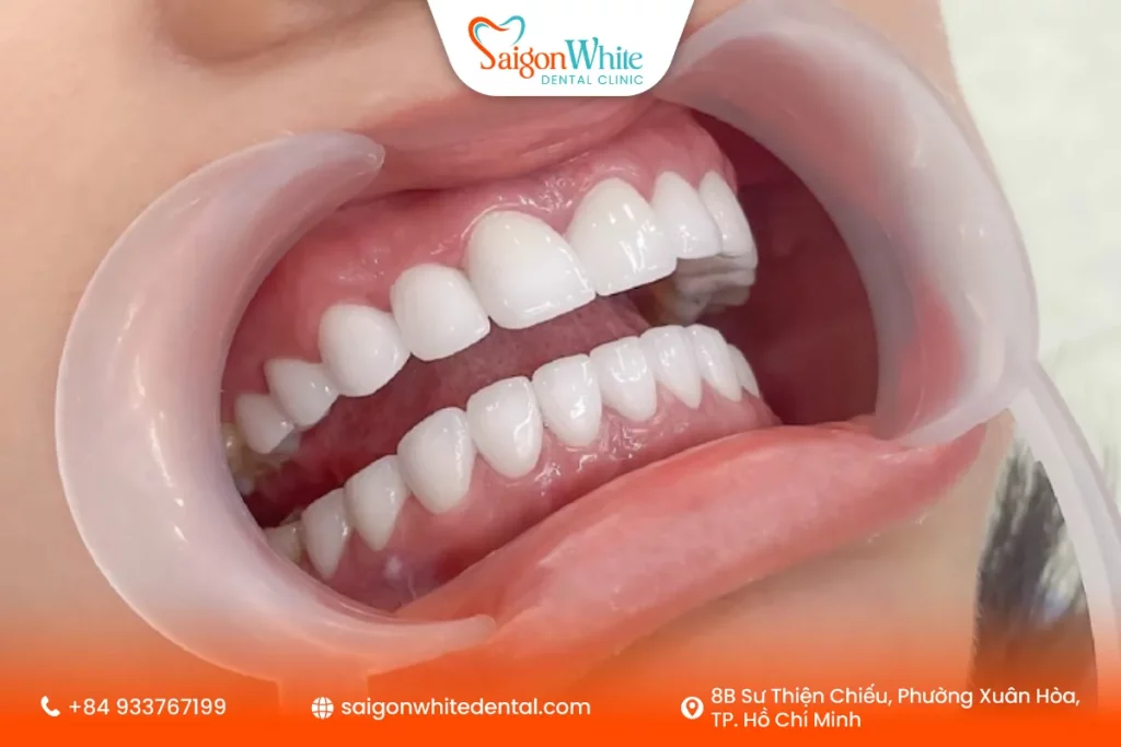 Thời điểm thích hợp để bọc răng sứ