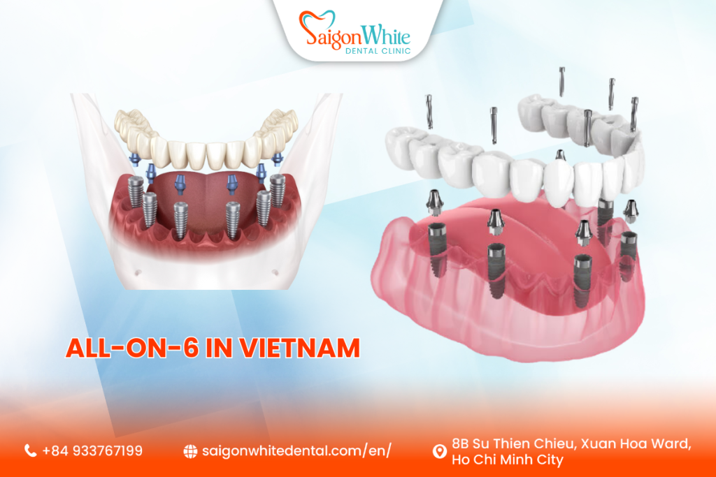 All-on-6 in Vietnam