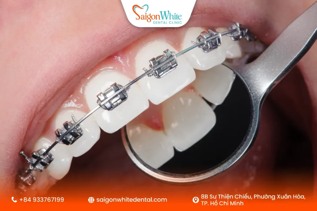 Cấu tạo của mắc cài