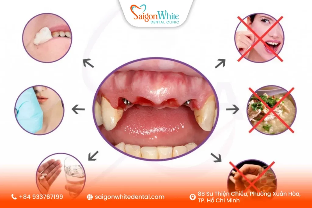 Chăm sóc răng Implant đúng cách sau khi cấy ghép
