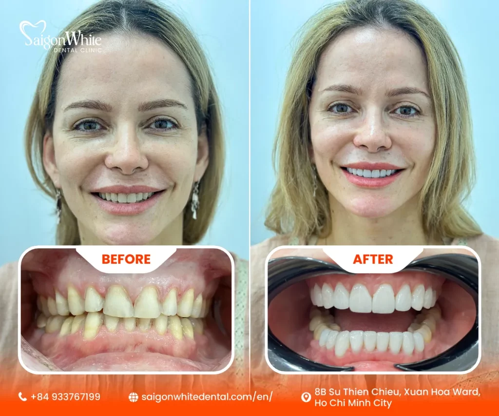 An international patient gets veneers at Saigon White Dental.