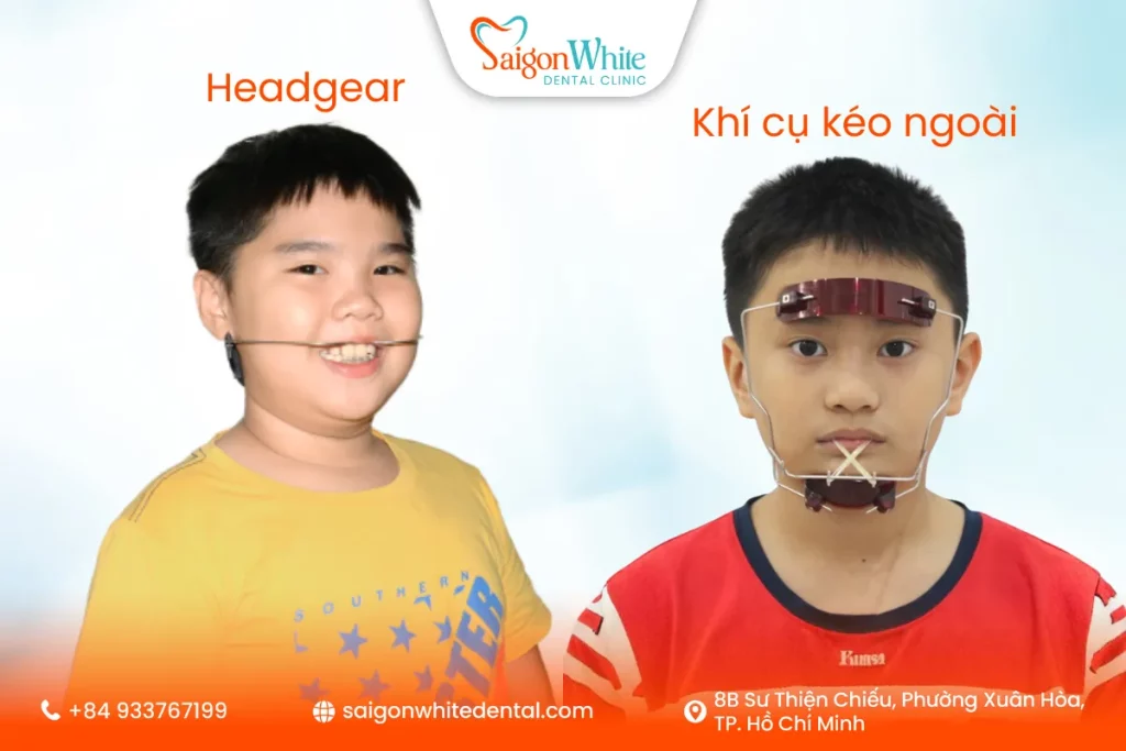 Headgear và khí cụ kéo ngoài