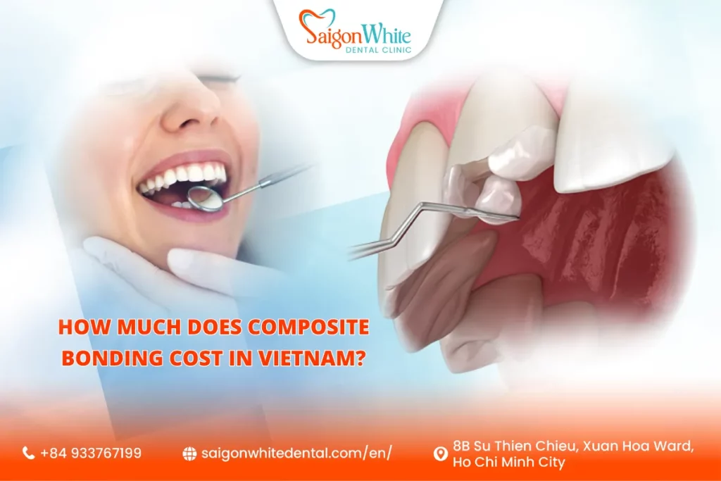 How Much Does Composite Bonding Cost in Vietnam?