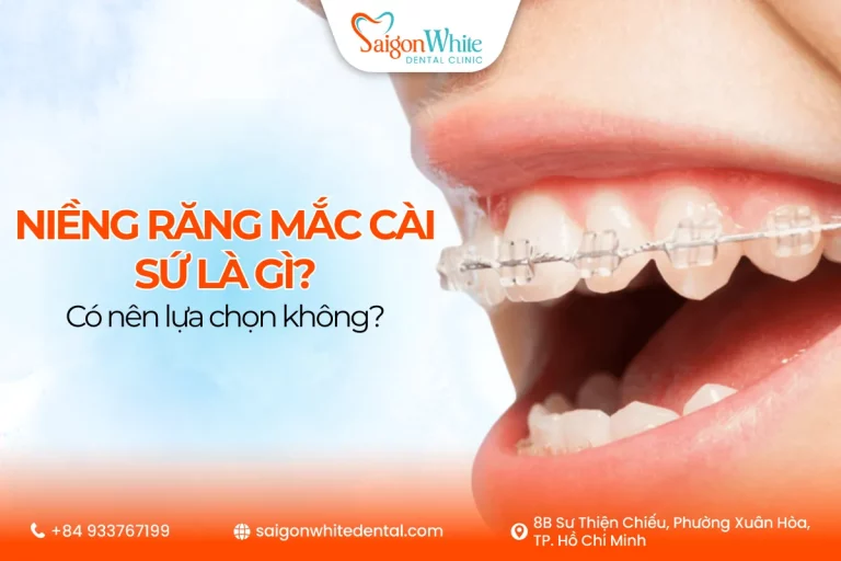 Niềng răng mắc cài sứ là gì