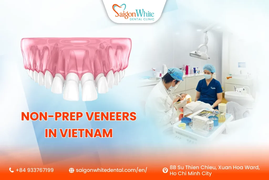 Non-Prep Veneers in Vietnam