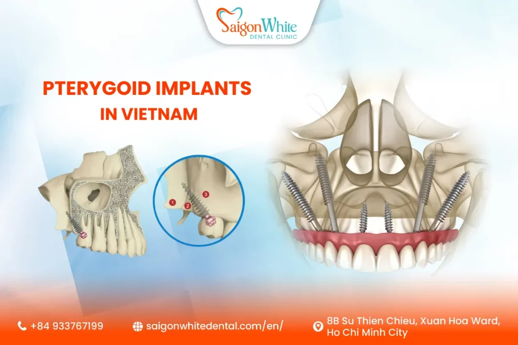 Pterygoid Implants in Vietnam: