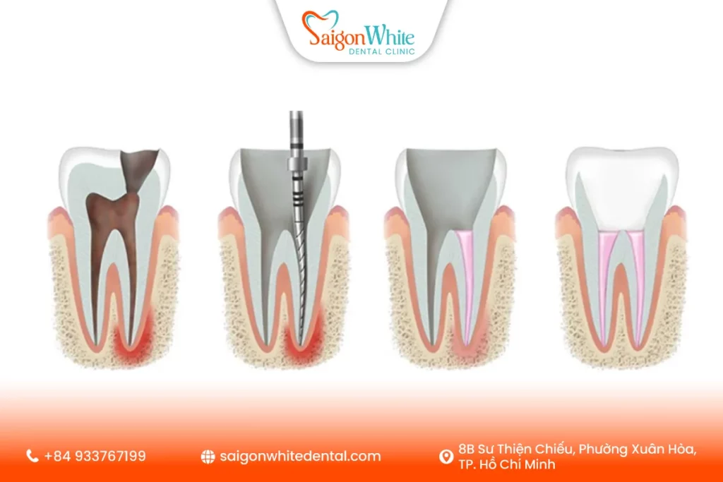 Quy trình điều trị tủy chuẩn nha khoa