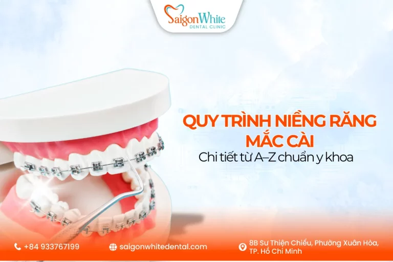 Quy trình niềng răng mắc cài chi tiết từ A-Z chuẩn y khoa