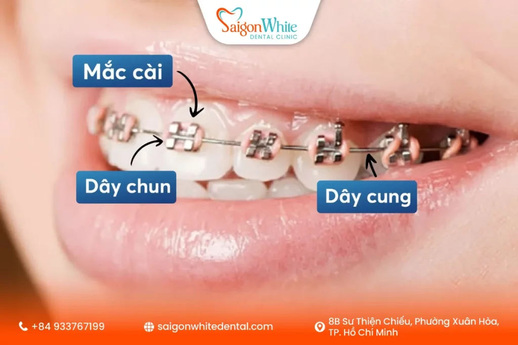 Ưu điểm của mắc cài kim loại