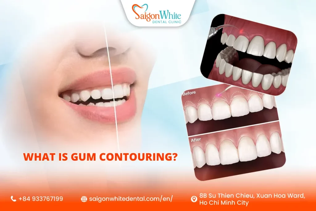 What Is Gum Contouring?