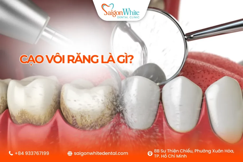 Cạo vôi răng là gì?