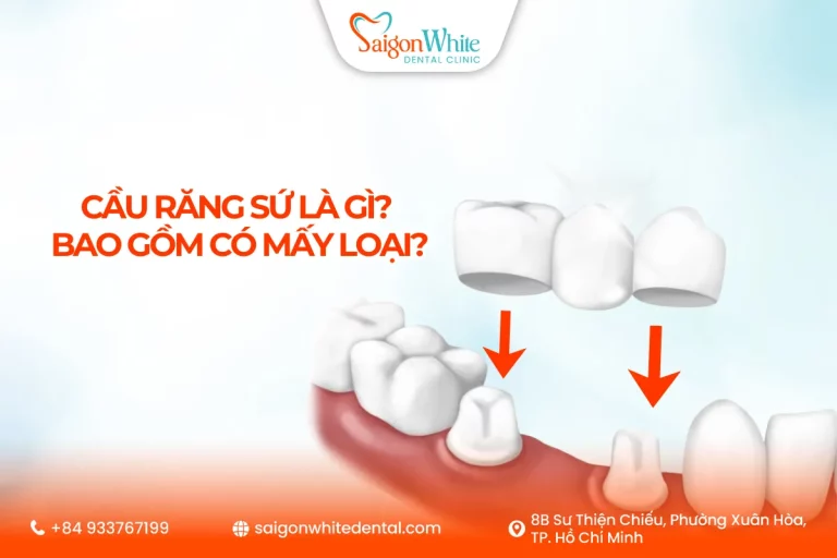Cầu răng sứ là gì? Bao gồm có mấy loại?