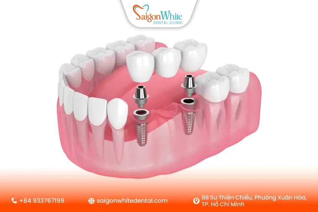 Cầu răng sứ trên implant