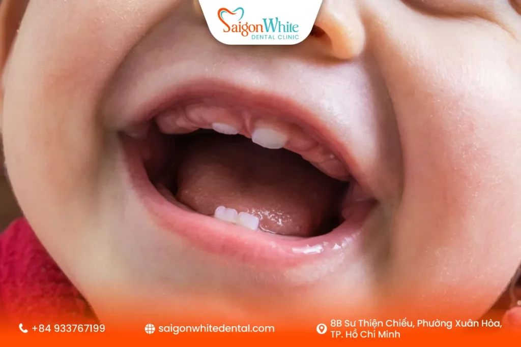 Dấu hiệu bé sắp mọc răng sữa