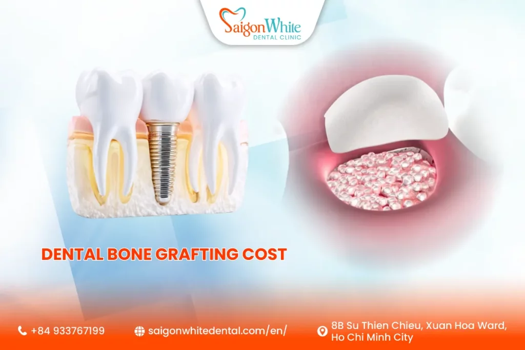How Much Does Dental Bone Grafting Cost and Why