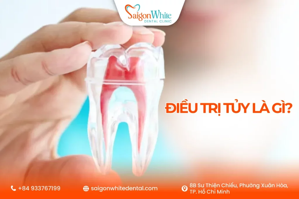 Điều trị tủy răng