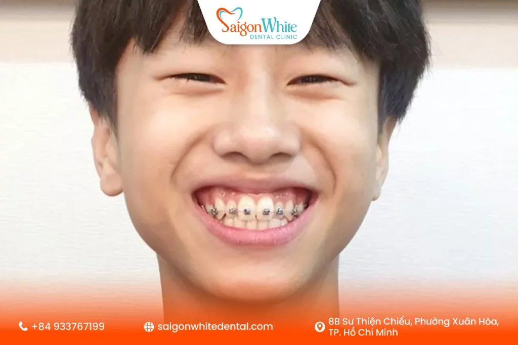 Mắc cài giai đoạn sớm (Early Braces)