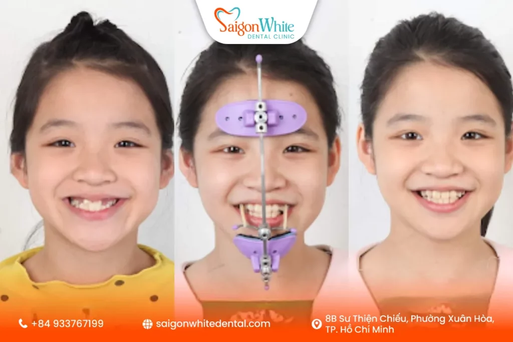 Khí cụ kéo ngoài (Headgear)