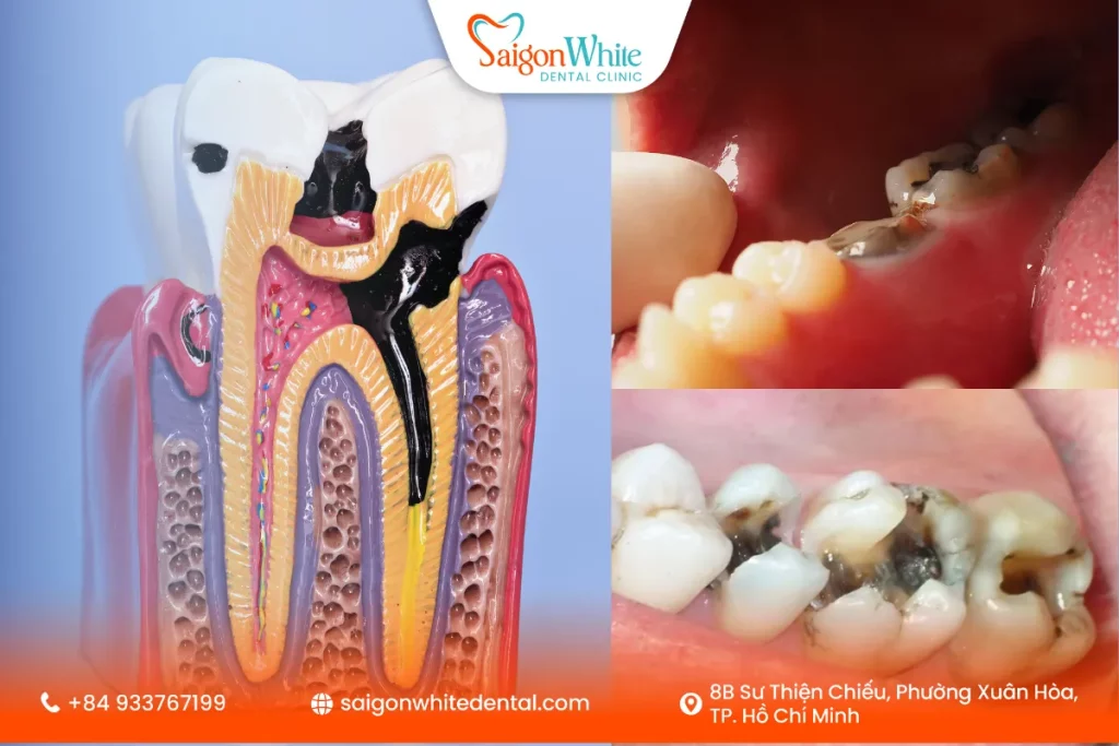Khi nào cần điều trị tủy?