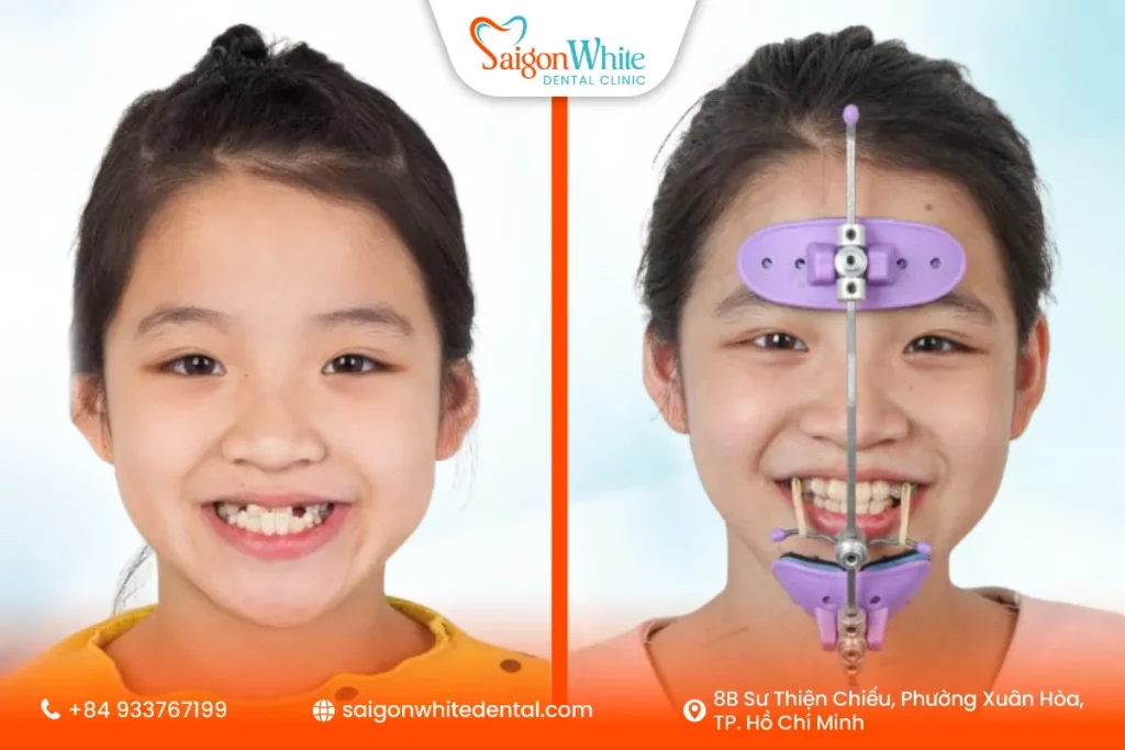 Khi niềng răng sớm sẽ giúp răng hàm bé phát triển đúng hướng