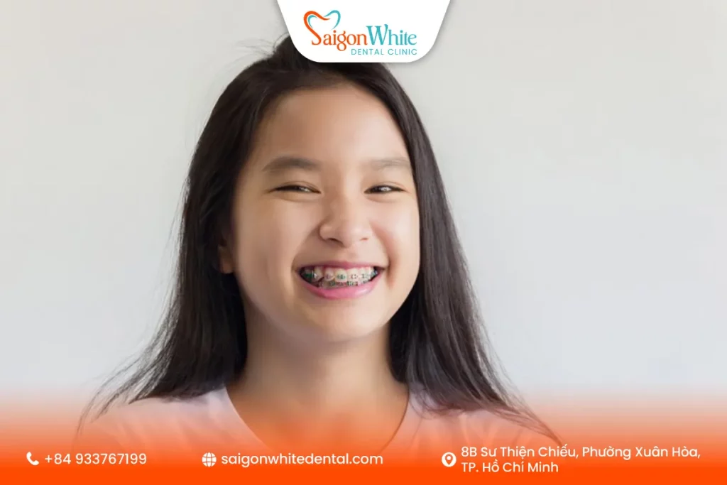 Khuôn mặt bé khi được chỉnh nha sớm sẽ cân đối đều đẹp