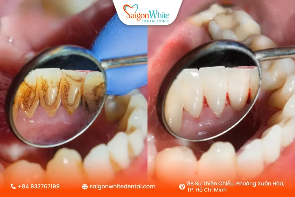 Lợi ích cạo vôi răng