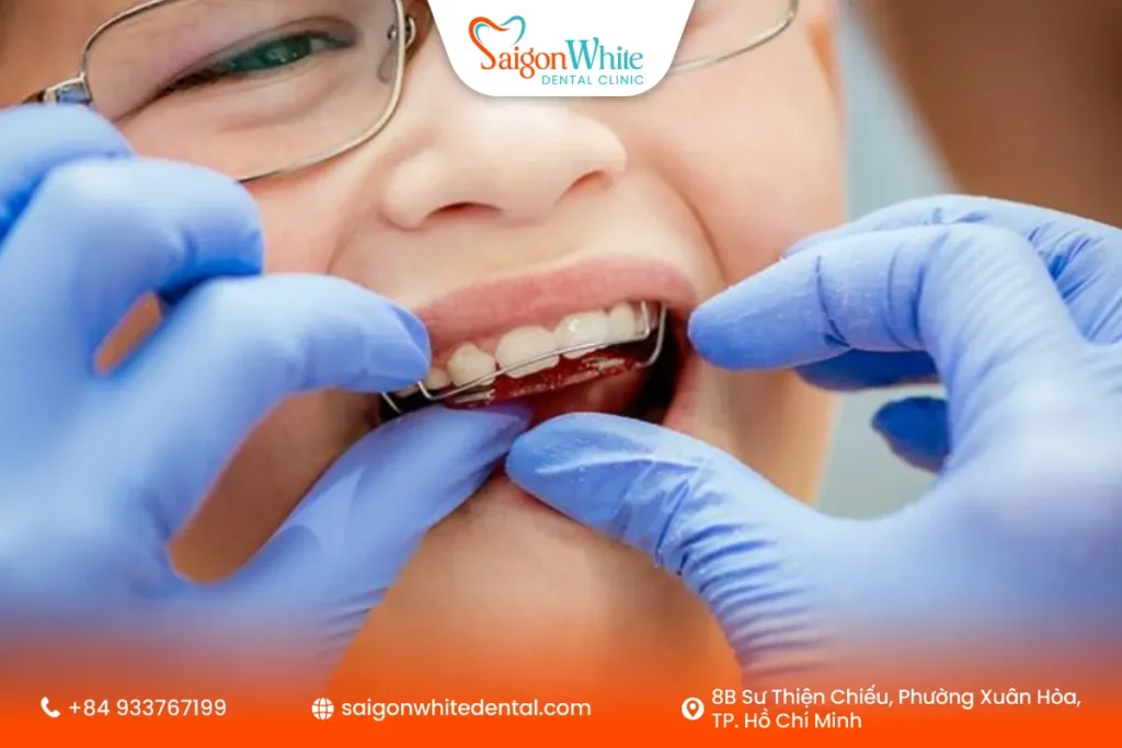 Lợi ích khi niềng răng tăng trưởng đúng quy trình