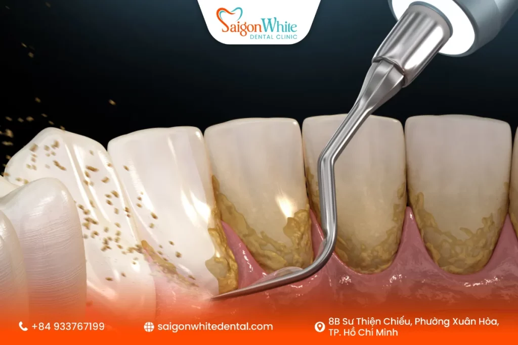 Cần lưu ý gì sau khi cạo vôi?