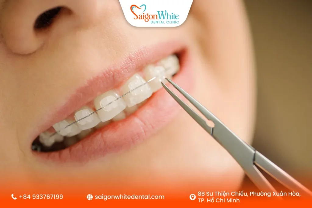 Niềng răng mắc cài sứ