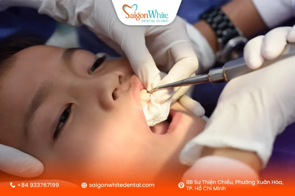 Quy trình nhổ răng sữa an toàn tại nha khoa