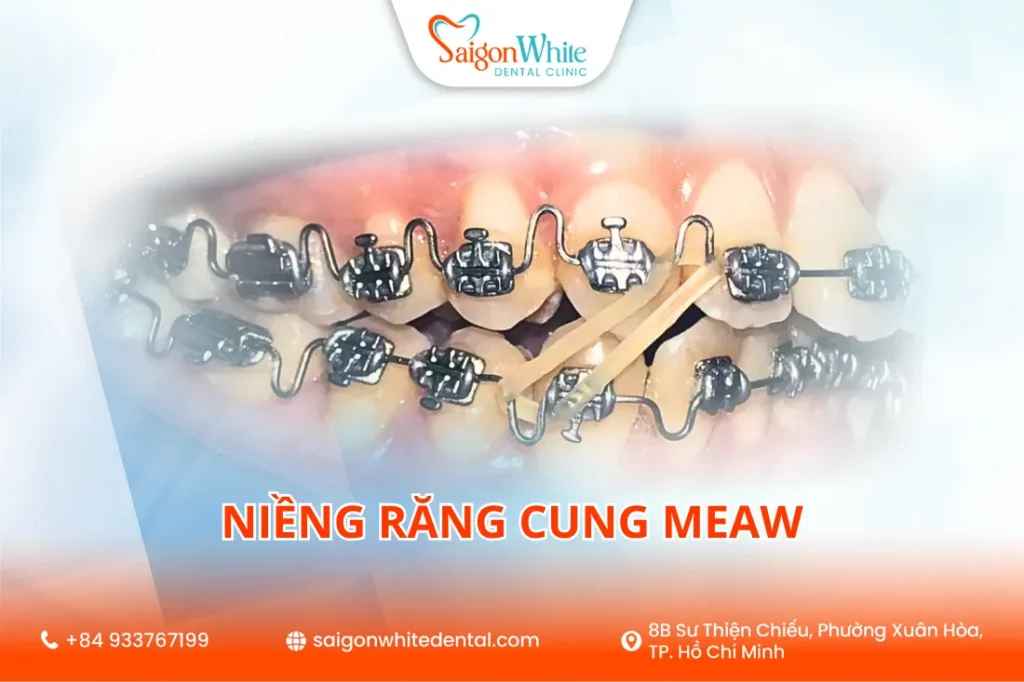 Niềng răng cung Meaw là gì?