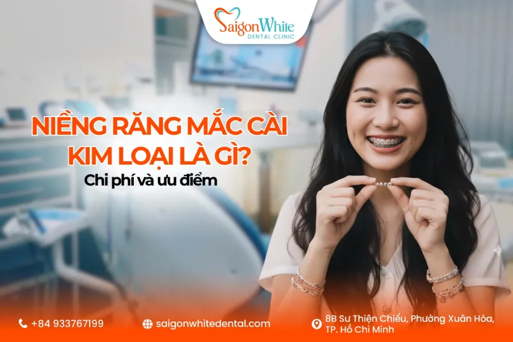 Niềng răng mắc cài kim loại
