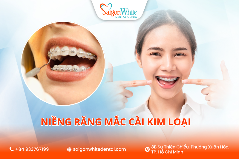 Niềng răng mắc cài kim loại