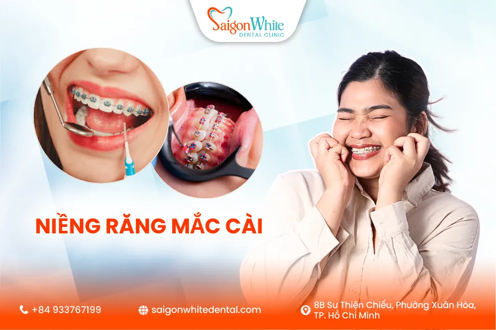 Niềng răng bằng mắc cài là gì?