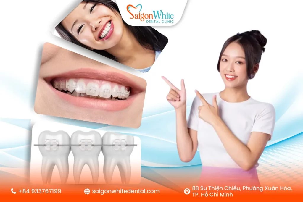 Niềng răng mắc cài sứ phù hợp với ai?