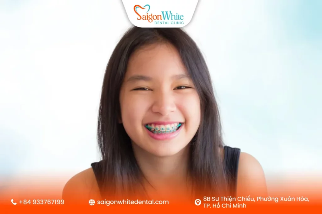 Niềng răng tăng trưởng cho bé